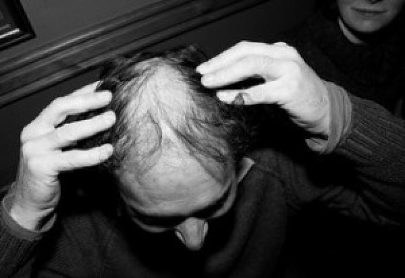 Costo del trapianto di capelli: attenzione agli eccessi