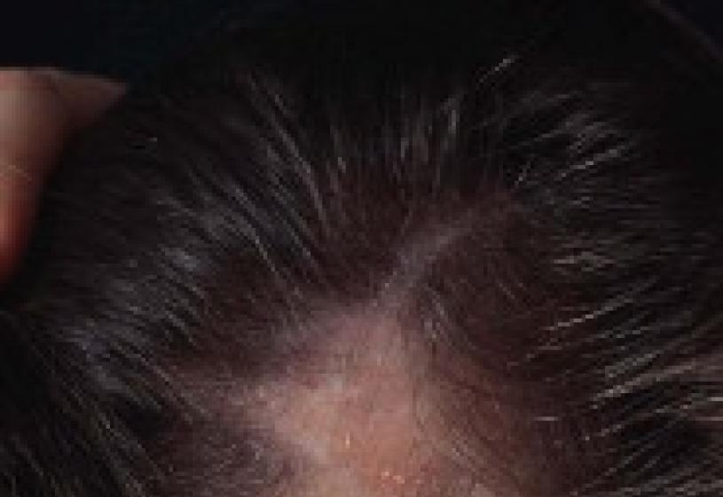 Cura per l'alopecia: tutto dipende dalle cause