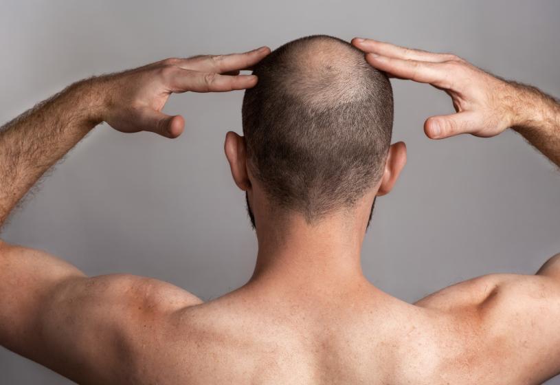 5 alternative alla parrucca per la perdita di capelli