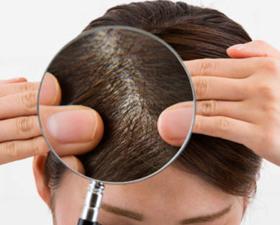Capelli esaminati con lente d'ingrandimento per problemi di cuoio capelluto.