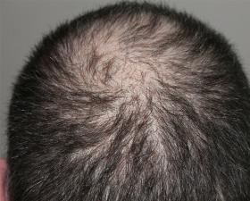 Capelli diradati su cuoio capelluto.