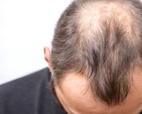 Uomo con diradamento dei capelli sulla sommità della testa.