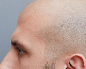 Testa rasata con tatuaggio capillare visibile.