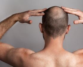 Uomo calvo di spalle con mani sulla testa.