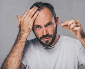 Uomo con problemi di perdita di capelli, preoccupato.