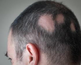 Alopecia areata con chiazze di perdita di capelli.