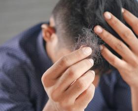 Uomo preoccupato con capelli in mano, segno di caduta.