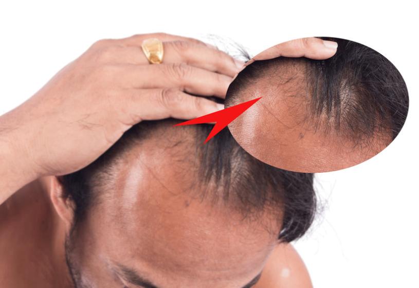 Le parrucche fanno perdere i capelli? La risposta di HairAid