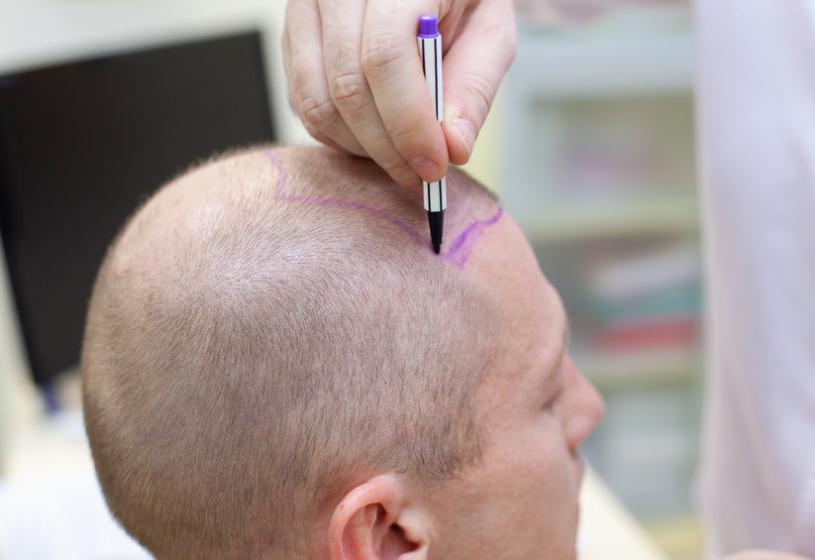 Trapianto di capelli e Covid: cosa sapere e come fare