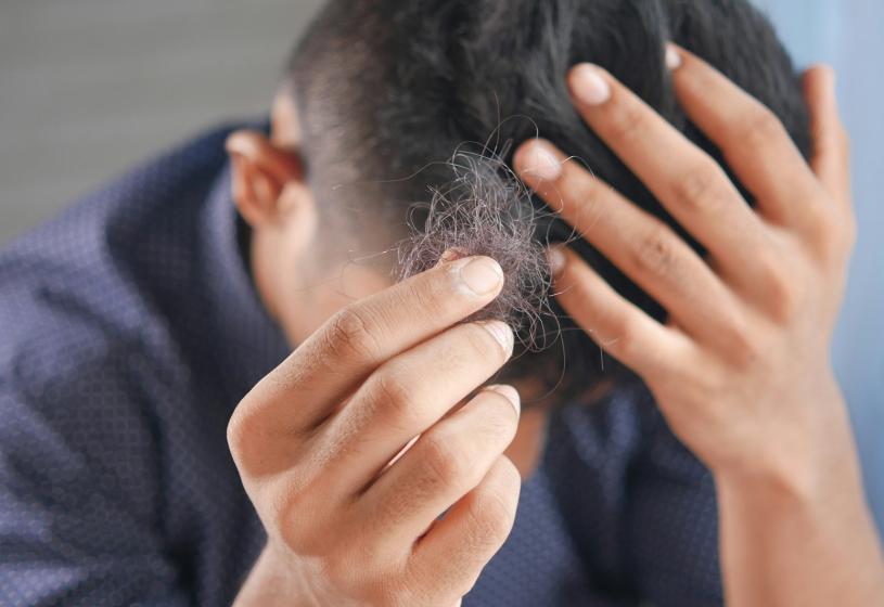 Alopecia androgenetica: cause, sintomi e percorsi