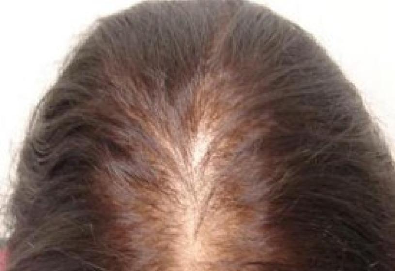 L’alopecia nelle donne: un fenomeno da controllare