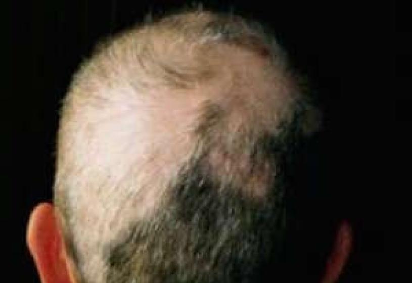 Quali sono i sintomi dell’alopecia areata?