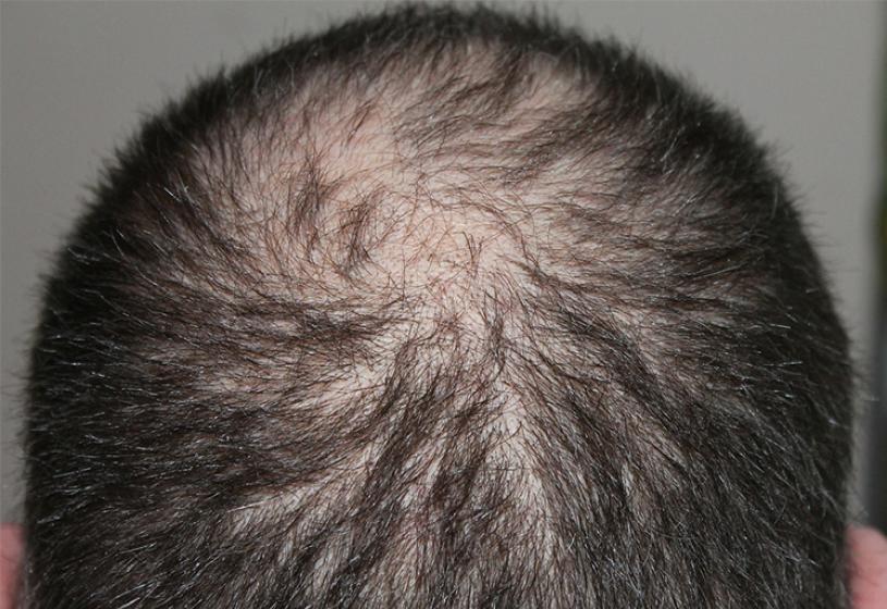 Alopecia areata: si può guarire senza farmaci?