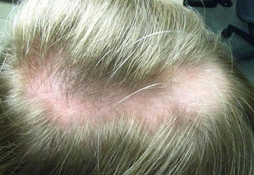 Alopecia seborroica: come si può guarire davvero?