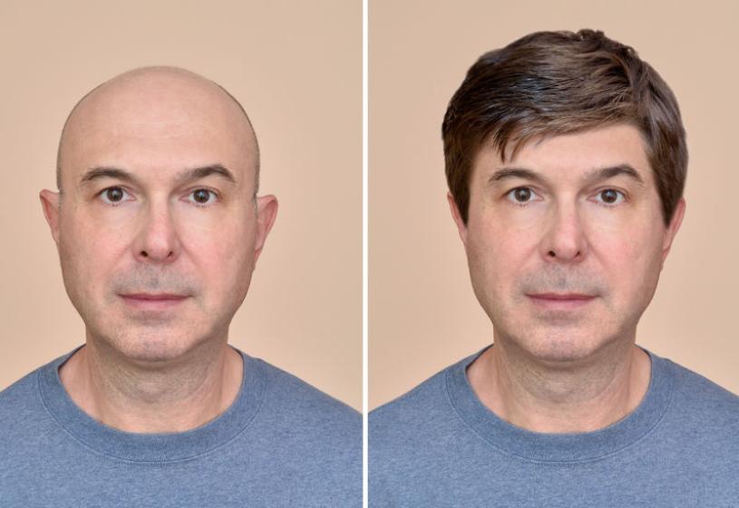 Parrucca per alopecia detraibile: come funziona