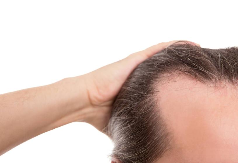 Alopecia a seguito di un trauma: si può curare?