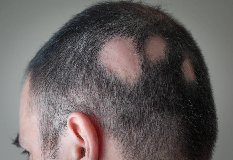 Le 5 terapie migliori all'alopecia areata